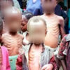 Top 15, pays africains, enfants mal nourris Togo
