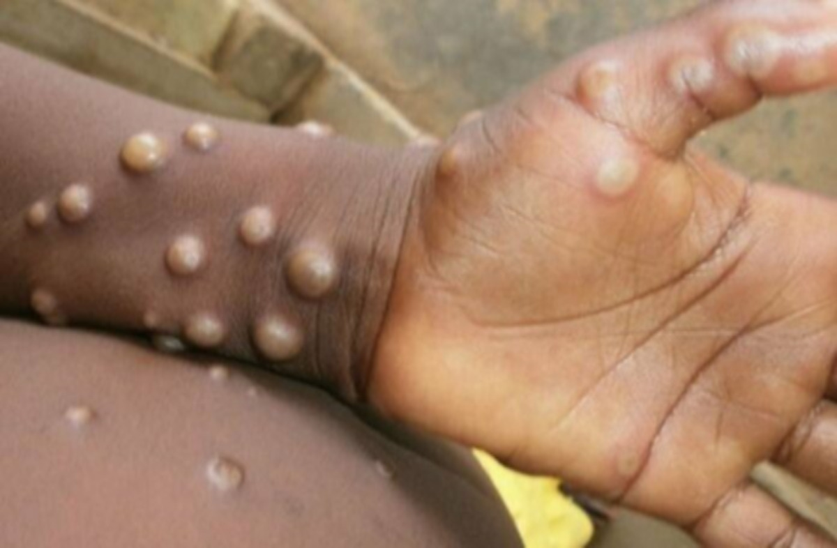 Épidémie de Mpox : Plusieurs cas confirmés en Côte d'Ivoire