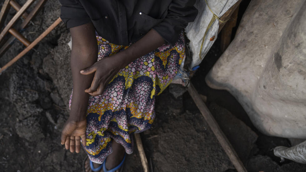 https://lomeactu.com/epidemie-de-mpox-le-gouvernement-guineen-prend-les-devants/