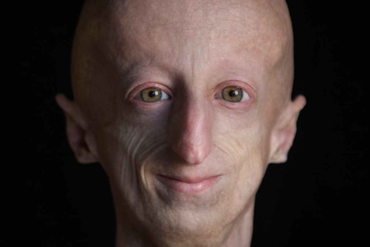 Le parcours remarquable de Sammy Basso malgré la progeria